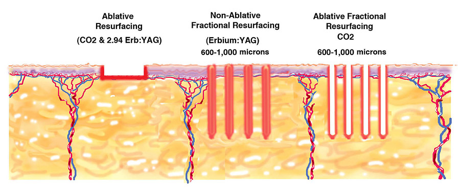 types-of-laser-resurfacing